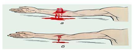 По рисунку определить вид кровотечения. Окажите из имеющихся подручных средств. 1. Какое кровотечени