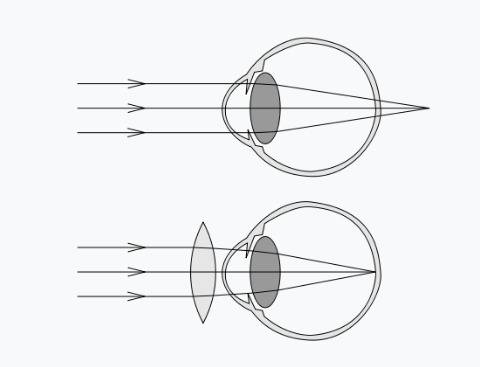 Если глаз человека строит изображение далеких предметов за сетчаткой, то глаз страдает 1) дальнозорк
