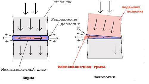 Ккаким последствиям для работы спинного мозга и его нервовов может искривление позвоночника, грыжа (