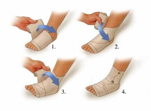 Аллгоритм обматывания эластичного бинта в ноге после операции на позвоночнике