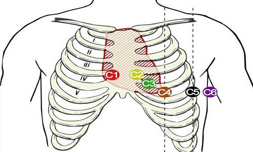 Наложение грудных электродов, желательно с картинкой и пояснениями
