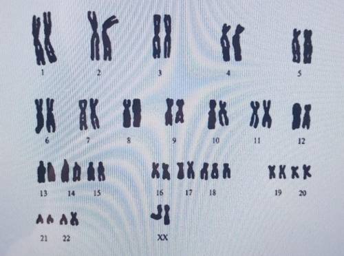 опишите кариограмму определите по кариотипу названия заболевания запишите развернутую формулу кариот