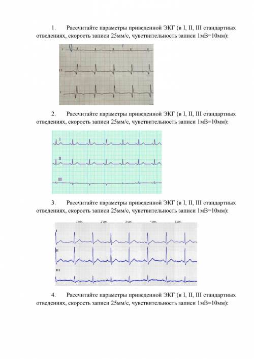 Задача номер 2 Рассчитайте параметры приведенной ЭКГ (в I,II,III стандартных отведениях, скорость за