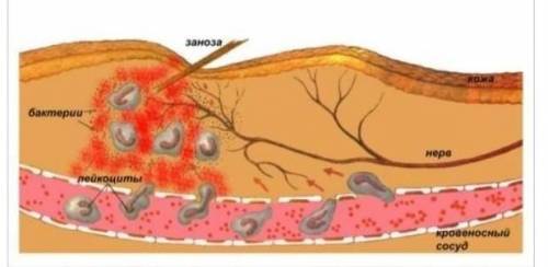 По рисунку объясните явление при воспалительном процессе попадании в кожу инородного тела. ​