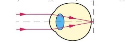 Какой недостаток зрения показан на рисунке? Нарисуйте необходимую линзу для исправления недостатка з