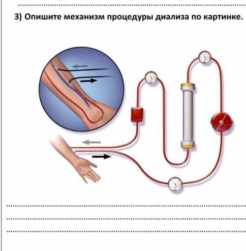 Опишите механизм процедуры диализа по картинке